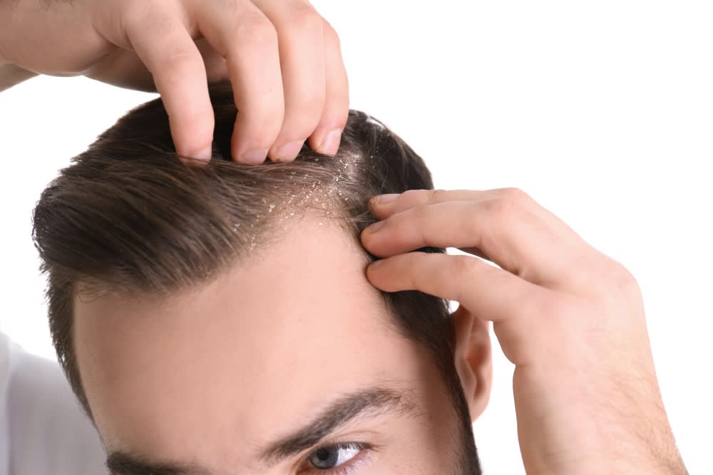 Dandruff Treatment in Royapettah